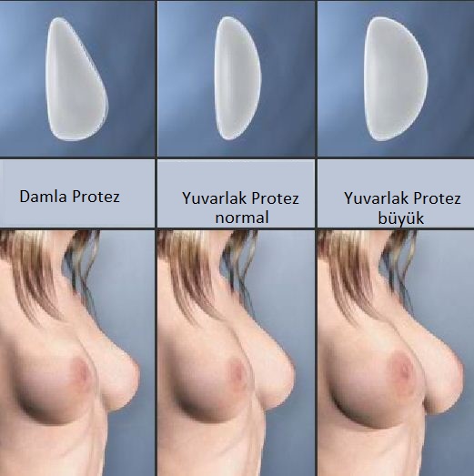увеличение груди фото